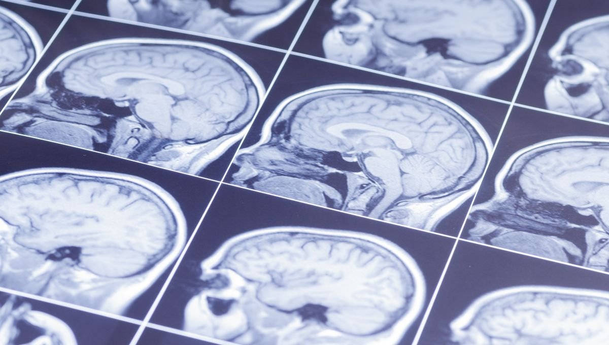 Estimulação cerebral personalizada leva paciente a remissão após 31 anos de depressão grave - Imagem do artigo